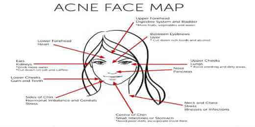 Acne Face Map – What Acne revealing about your Health